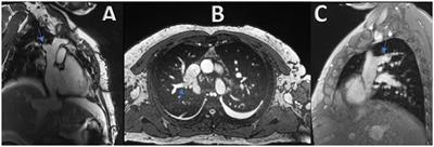 Case Report: Constrictive Pericarditis in a Patient With Isolated Anomalous Right Upper Pulmonary Venous Return